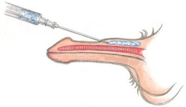 injekčné zväčšenie penisu